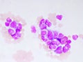 Chronic myeloid leukemia cells or CML Royalty Free Stock Photo