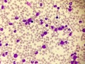 Chronic myeloid leukemia CML. Red blood cell. Blood smear