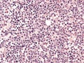 Chronic myeloid leukemia, bone marrow. Royalty Free Stock Photo
