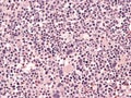 Chronic myeloid leukemia, bone marrow. Royalty Free Stock Photo