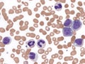 Chronic myeloid leukemia, peripheral blood Royalty Free Stock Photo