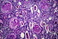 Chronic nephritis, light micrograph