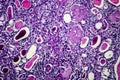 Chronic nephritis, light micrograph