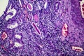 Chronic nephritis, light micrograph