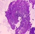 Chronic nonspecific ileitis. Section show ileal mucosa in lamina propria. IBD.