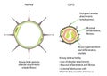 Chronic obstructive pulmonary disease