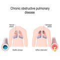 Chronic obstructive pulmonary disease COPD Royalty Free Stock Photo