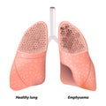 Chronic obstructive pulmonary disease Royalty Free Stock Photo