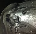 Shoulder burcitis glenohumeral osteoarthrosis Royalty Free Stock Photo