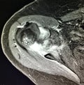 Shoulder burcitis glenohumeral osteoarthrosis