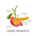 Chronic pancreatitis concept. Vector illustration Royalty Free Stock Photo