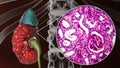Chronic pyelonephritis, illustration and light micrograph