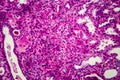 Chronic pyelonephritis, light micrograph