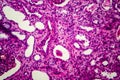 Chronic pyelonephritis, light micrograph