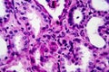 Chronic pyelonephritis, light micrograph