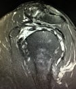 Chronic shoulder pain glenohumeral joint mri