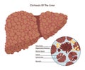 Cirrhosis of the liver. Fibrosis of the liver tissue caused by long-term