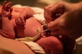 Clamping umbilical cord after birth Royalty Free Stock Photo