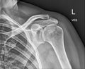 Clavicle bone, Shoulder Medical Xray Royalty Free Stock Photo