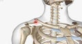 A clavicle fracture is a break in the collarbone, one of the bones in the shoulder