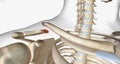 A clavicle fracture is a break in the collarbone, one of the bones in the shoulder