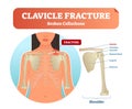 Clavicle fracture with broken collarbone vector illustration. Medical and anatomical labeled scheme with clavicle fracture. Royalty Free Stock Photo