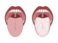 Clean Healthy Tongue and White Coated Tongue.