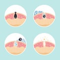 Cleaning clogged pores process flat vector illustration. Steps of blackheads, sebum or pimples removal, skin cleaning