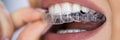 Clear Aligner Dental Night Guard Royalty Free Stock Photo