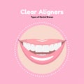 Clear Dental Alighers.