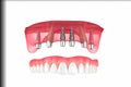 Dental implant model showing upper jaw and prosthetic teeth Royalty Free Stock Photo