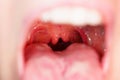 Cleft, bifurcation of the uvula. malformations.