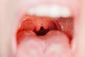 Cleft, bifurcation of the uvula. malformations. Royalty Free Stock Photo