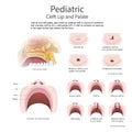 Cleft lip and cleft palate. Vector Art, Illustration.