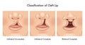 Cleft lip medical illustration