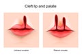 Cleft lip and cleft palate