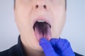 Close-up of a man black tongue. Clinical manifestations of lingua villosa. Bacterial infection of the mouth. The consequences of