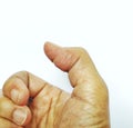 Clinical of Trigger finger right thumb in patient in hospital.