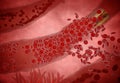 Clogged Artery with platelets and cholesterol plaque, concept for health risk for obesity or dieting and nutrition problems Royalty Free Stock Photo