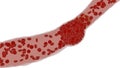 Clogged Artery with platelets and cholesterol plaque, concept for health risk for obesity Royalty Free Stock Photo