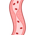 Clogged Artery with platelets and cholesterol plaque. Cholesterol: Types, Importance, Prevention and Treatment. Disease Control.