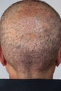 Close back man`s head who has done a self hair transplant