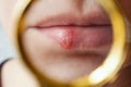 close female lips affected by herpes simplex virus, swelling and blisters on the lips Royalty Free Stock Photo