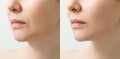 A close portrait of an aged woman before and after facial rejuvenation procedure. Correction of the chin shape Royalty Free Stock Photo