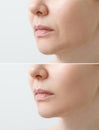 A close portrait of an aged woman before and after facial rejuvenation procedure. Correction of the chin shape Royalty Free Stock Photo