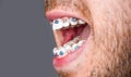 Close to the teeth braces on the white teeth of man to equalize the teeth. Bracket system in smiling mouth, macro photo Royalty Free Stock Photo