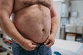 Close up of abdomen of overweight patient. High waist circumference of obese man, belly fat. Concept of health risks of Royalty Free Stock Photo