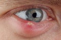 Close up abscess in the eye. hordeolum. stybarley on the eye. inflammation. stye Royalty Free Stock Photo
