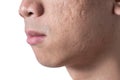 Close-up acne and scars on asian man face