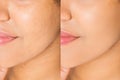 Before after close up african american woman face with acne and problem skin. Beauty skin care treatment. Before-after Facial